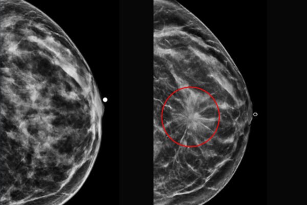 How 3D Mammography and Breast MRI Detect Early Breast Cancer ...