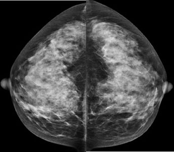 How 3D Mammography and Breast MRI Detect Early Breast Cancer 3D Mammography and Breast MRI dedection